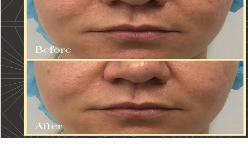Thread Lift Procedure And What To Expect