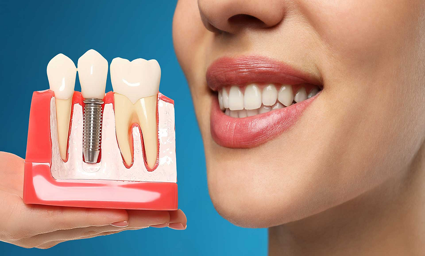 Benefits of Surgical Placement of Dental Implants